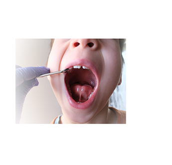 Clinical illustration relating to tongue-tie treatment
