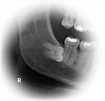 Dental X-ray showing an impacted wisdom tooth